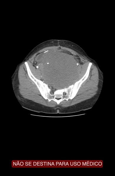 File:Abdominal desmoid tumor (Radiopaedia 44024-47540 Axial C+ arterial phase 37).jpg