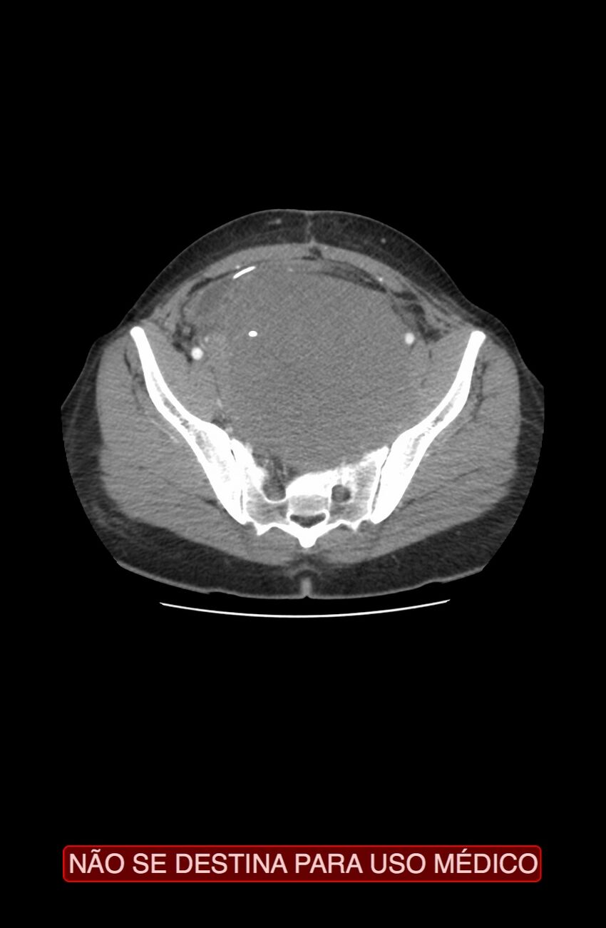 Abdominal desmoid tumor (Radiopaedia 44024-47540 Axial C+ arterial phase 37).jpg
