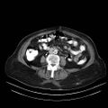 Abdominal wall recurrence after colorectal resection for cancer (Radiopaedia 23444-23523 Axial C+ portal venous phase 18).jpg