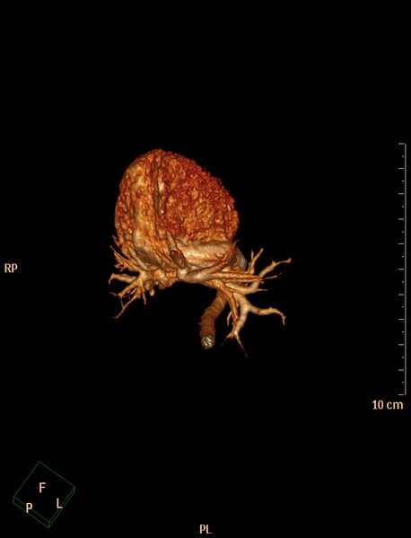 File:Aberrant left pulmonary artery (pulmonary sling) (Radiopaedia 42323-45435 3D reconstruction C+ CTPA 9).jpg