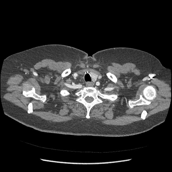 File:Aberrant right subclavian and left vertebral arteries (Radiopaedia 43467-46847 Axial C+ portal venous phase 8).jpg