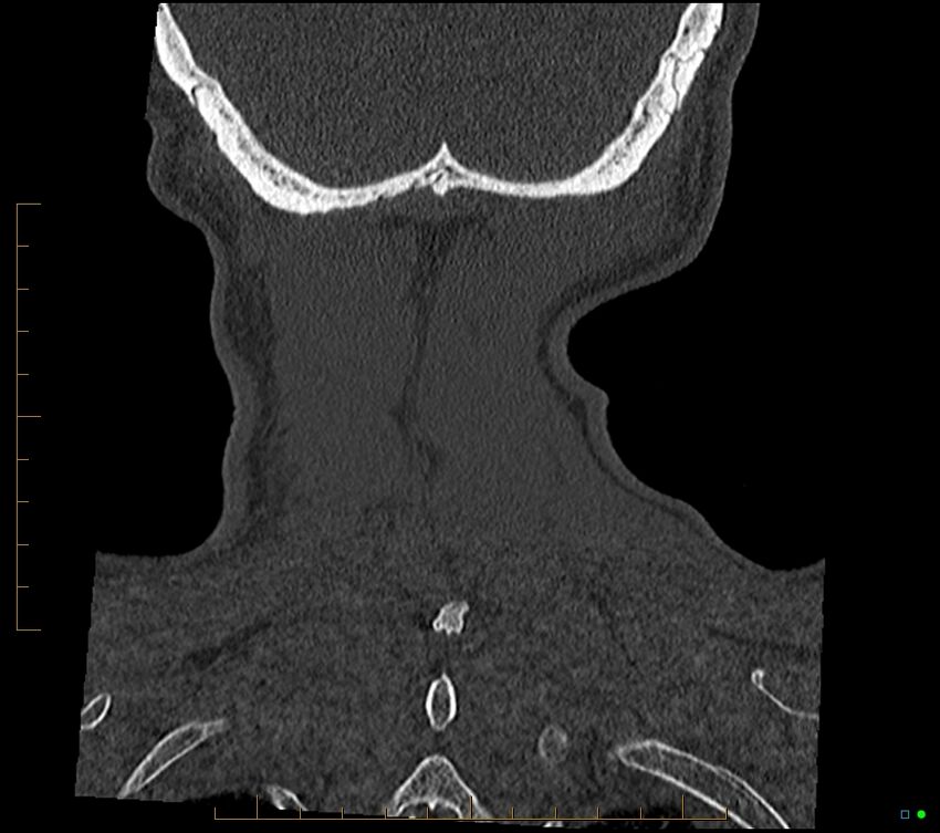 Accessory articulation of cervical transverse processes (Radiopaedia 82715-96933 Coronal non-contrast 107).jpg