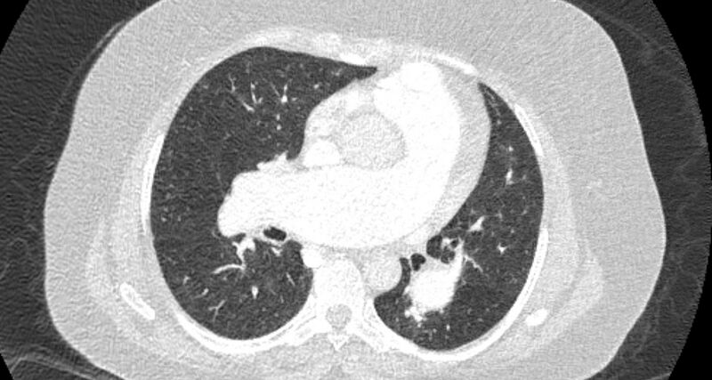 File:Accessory right inferior hepatic vein (Radiopaedia 65245-74259 Axial lung window 35).jpg