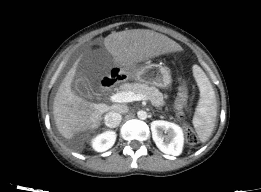 Acute Budd-Chiari syndrome (Radiopaedia 60858-68638 Axial C+ portal venous phase 108).jpg