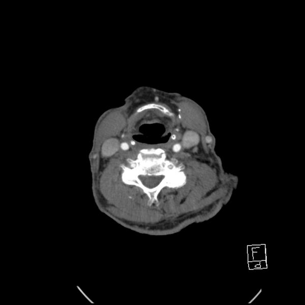 File:Acute ICA ischemic penumbra due to high-grade CCA stenosis (CT perfusion) (Radiopaedia 72038-82530 Axial C+ arterial phase 50).jpg