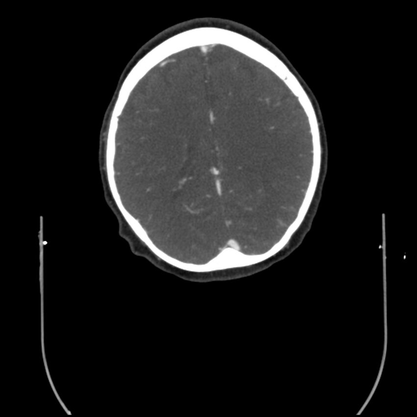 Acute M1 occlusion with ischemic penumbra (CT perfusion) (Radiopaedia 71897-82344 Axial C+ arterial phase thins 15).jpg