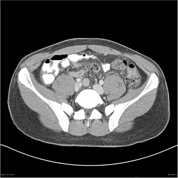 File:Acute appendicitis (Radiopaedia 25364-25615 B 49).jpg