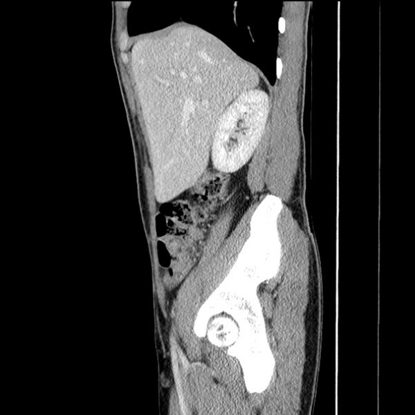 File:Acute appendicitis (Radiopaedia 27049-27227 Sagittal C+ portal venous phase 21).jpg