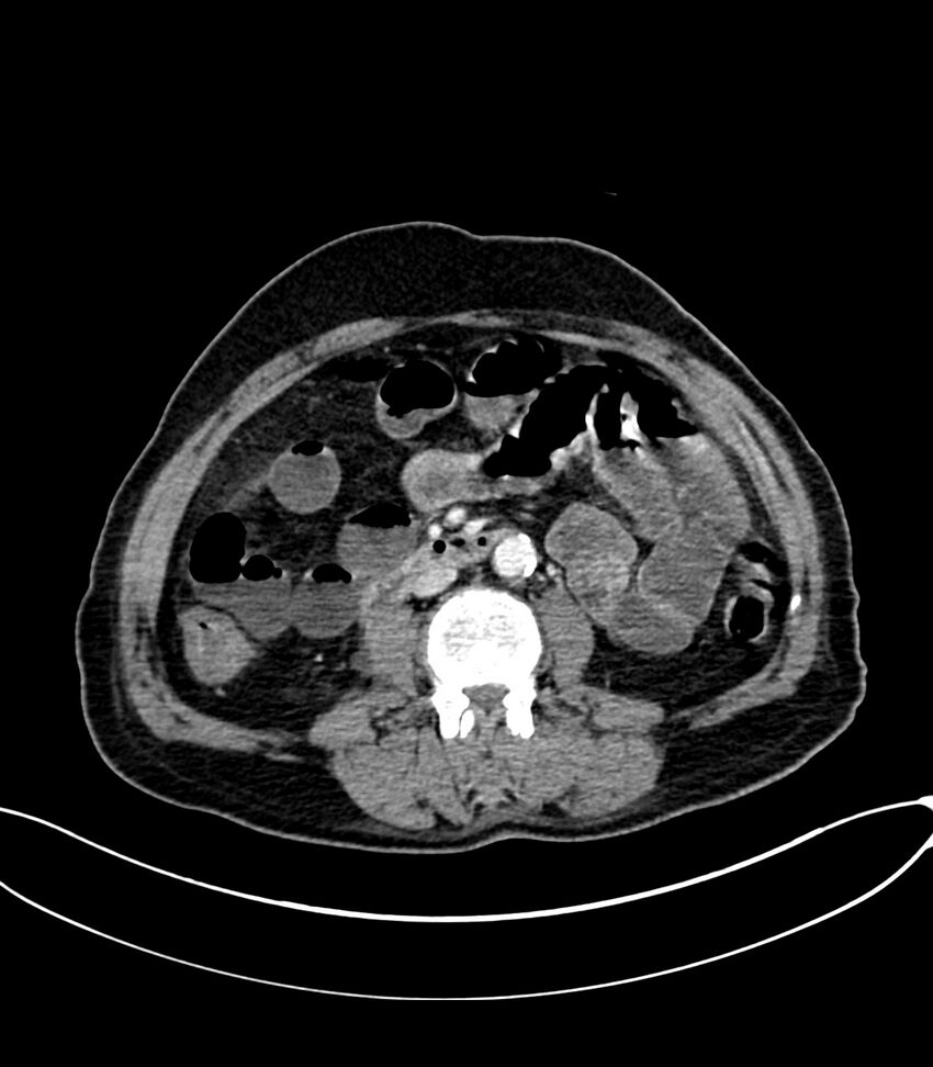 Acute arterial mesenteric ischemia (Radiopaedia 78238-90828 Axial C+ portal venous phase 69).jpg