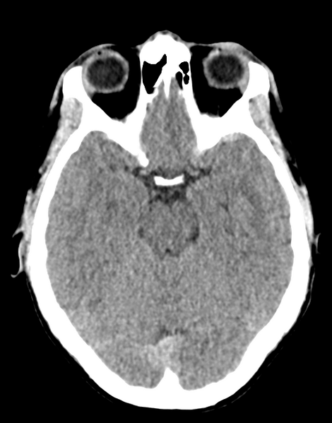 File:Acute disseminated encephalomyelitis (ADEM) (Radiopaedia 65319-74348 Axial non-contrast 12).png