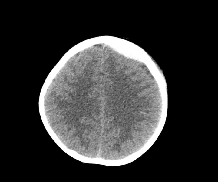 File:Acute epidural hematoma (Radiopaedia 63659-72335 Axial non-contrast 17).jpg