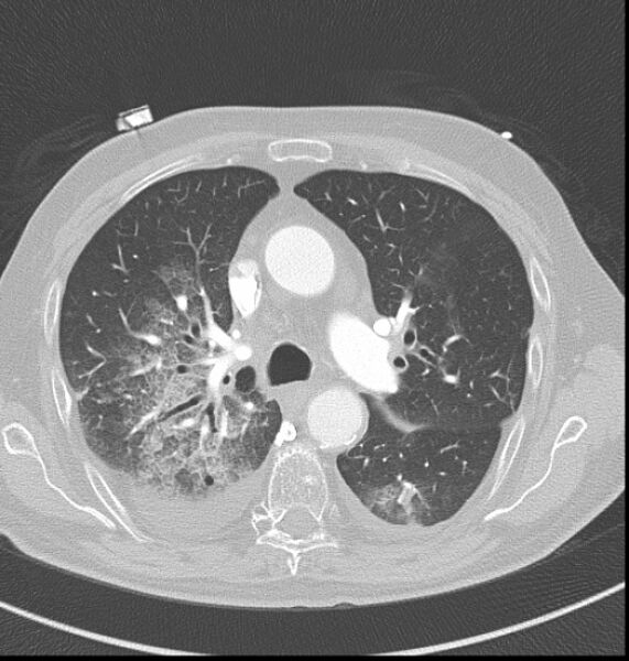 File:Acute myocardial infarction (Radiopaedia 23413-23481 lung window 14).jpg
