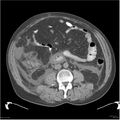 Acute pancreatitis (Radiopaedia 19135-19116 Axial non-contrast 31).jpg