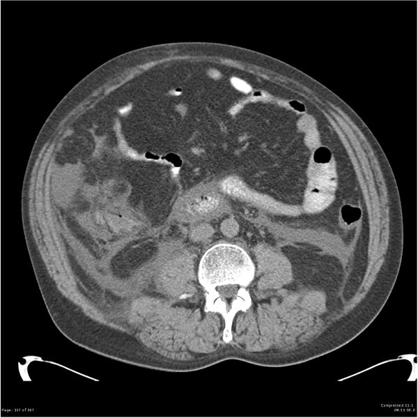 File:Acute pancreatitis (Radiopaedia 19135-19116 Axial non-contrast 31).jpg