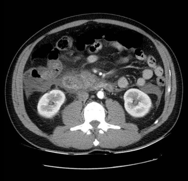 File:Acute pancreatitis - Balthazar E (Radiopaedia 23080-23110 Axial C+ arterial phase 34).jpg