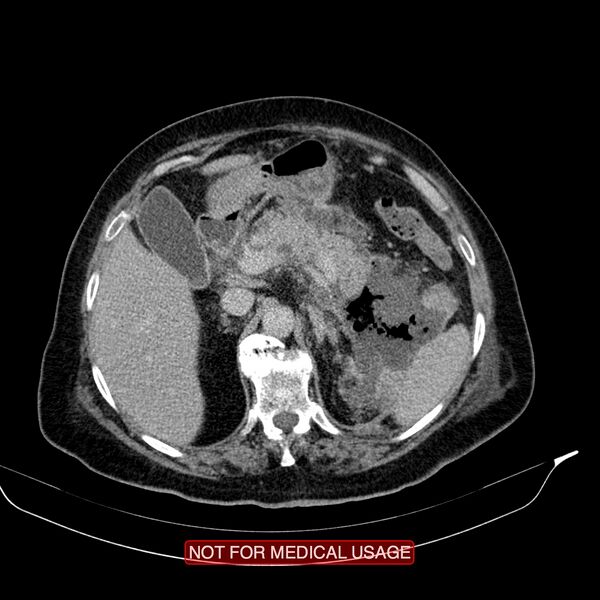 File:Acute pancreatitis with infected necrosis (Radiopaedia 26454-26585 Axial C+ delayed 10).jpg