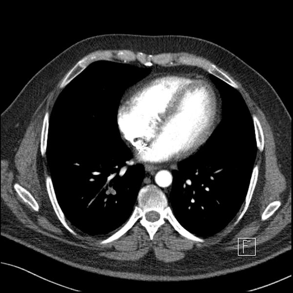 File:Acute pulmonary embolism with pulmonary infarct (Radiopaedia 73062-83768 Axial C+ CTPA 50).jpg