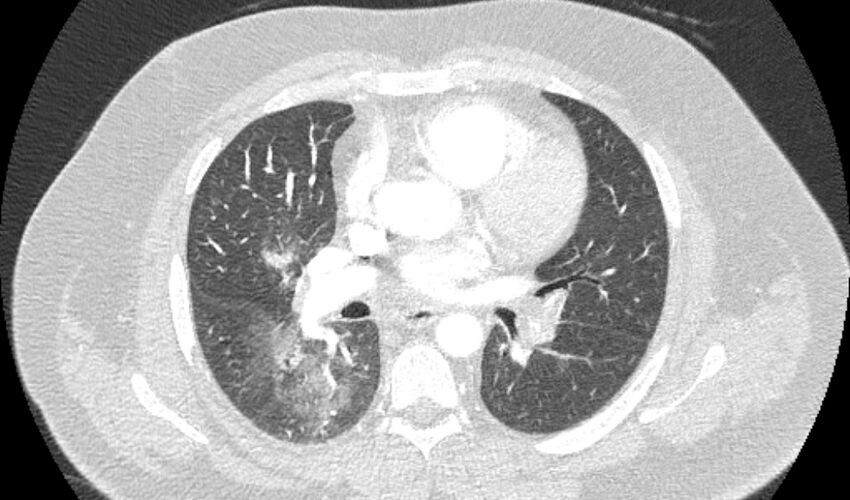 Acute pulmonary embolism with pulmonary infarcts (Radiopaedia 77688-89908 Axial lung window 57).jpg
