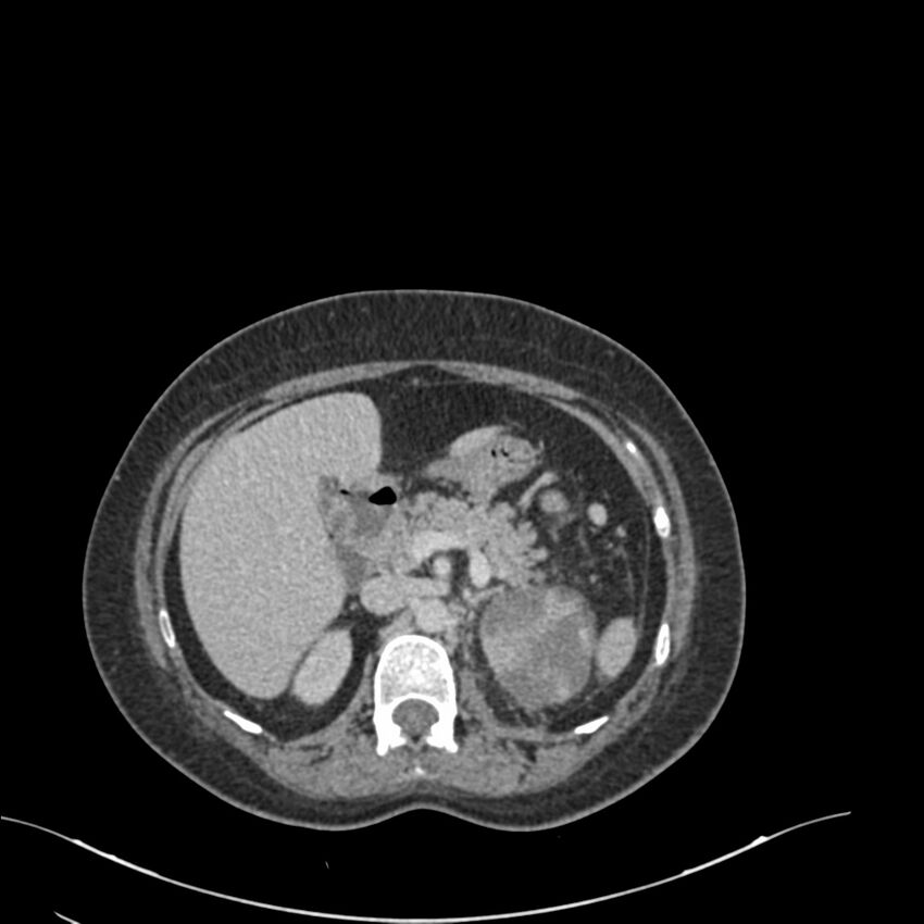 Acute pyelonephritis with renal vein thrombosis (Radiopaedia 58020-65053 Axial renal parenchymal phase 28).jpg