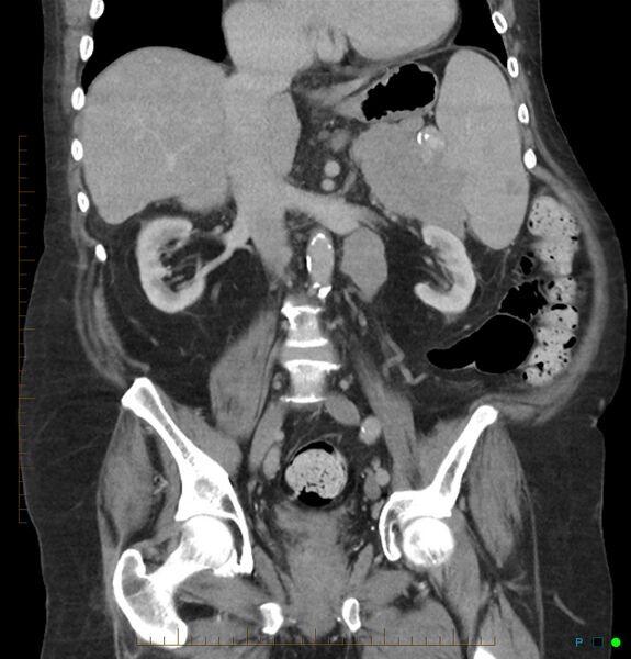 File:Acute renal failure post IV contrast injection- CT findings (Radiopaedia 47815-52559 Coronal C+ portal venous phase 16).jpg