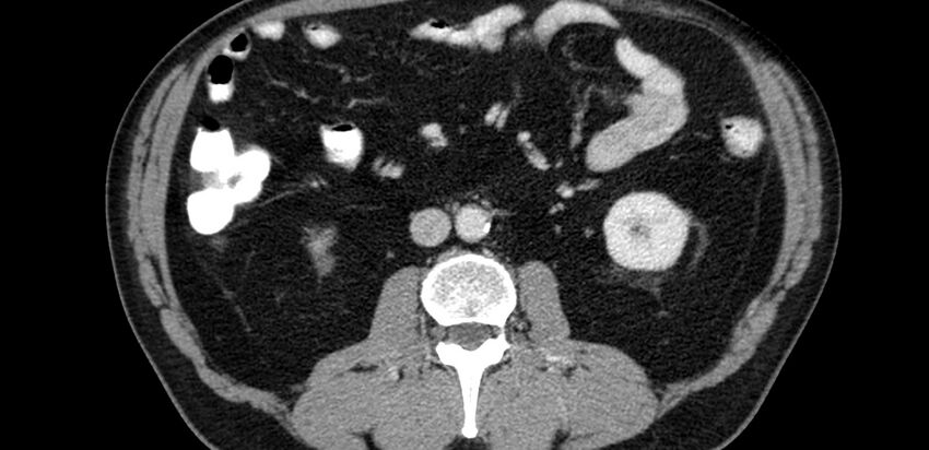 Acute sigmoid colon diverticulitis (Radiopaedia 55507-61976 Axial C+ portal venous phase 12).jpg