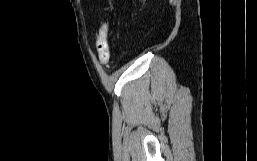 Acute sigmoid colon diverticulitis (Radiopaedia 55507-61976 Sagittal C+ portal venous phase 132).jpg