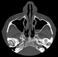 Acute sinusitis (Radiopaedia 23161-23215 Axial bone window 24).jpg