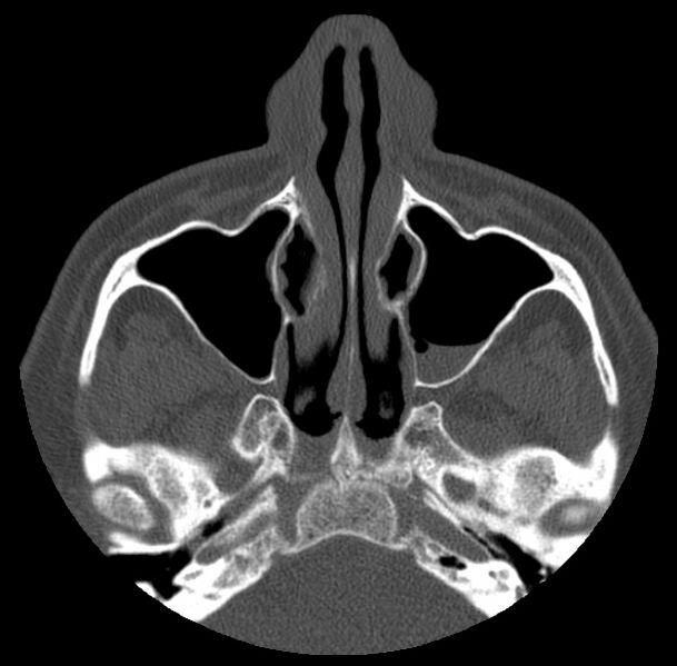 File:Acute sinusitis (Radiopaedia 23161-23215 Axial bone window 24).jpg