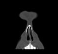 Acute sinusitis (Radiopaedia 23161-23215 Coronal bone window 16).jpg