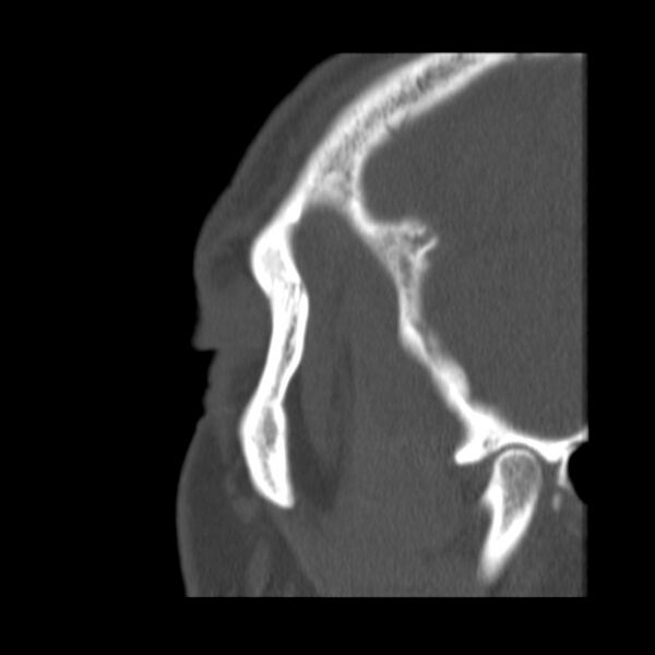 File:Acute sinusitis (Radiopaedia 23161-23215 Sagittal bone window 8).jpg
