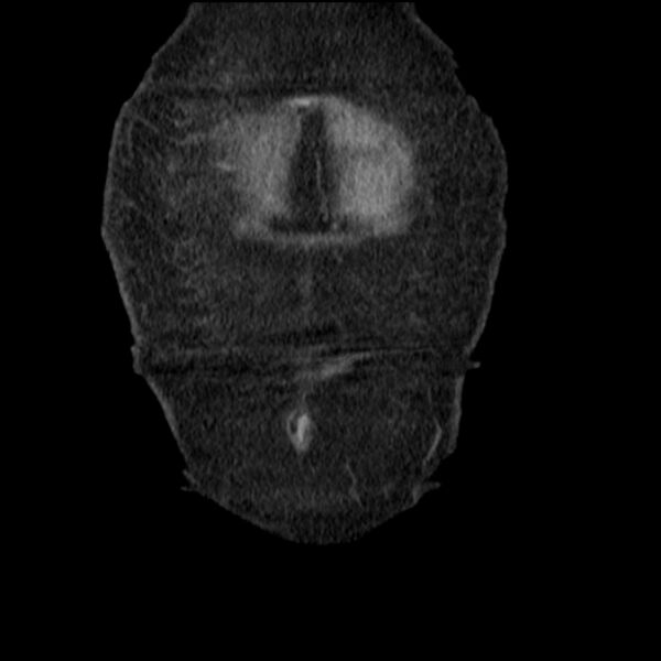 File:Acute tubular necrosis (Radiopaedia 28077-28334 D 10).jpg