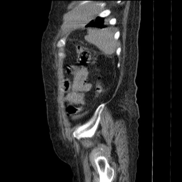File:Acute tubular necrosis (Radiopaedia 28077-28334 H 73).jpg