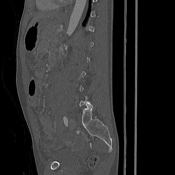 File:Acute vertebral body compression fractures (Radiopaedia 31757-32693 Sagittal bone window 12).jpg