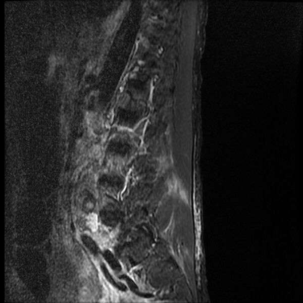 File:Acute vertebral body compression fractures (Radiopaedia 31757-32694 Sagittal STIR 3).jpg
