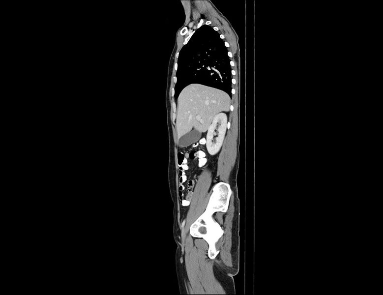 File:Addison disease (Radiopaedia 49318-54412 Sagittal C+ portal venous phase 48).jpg