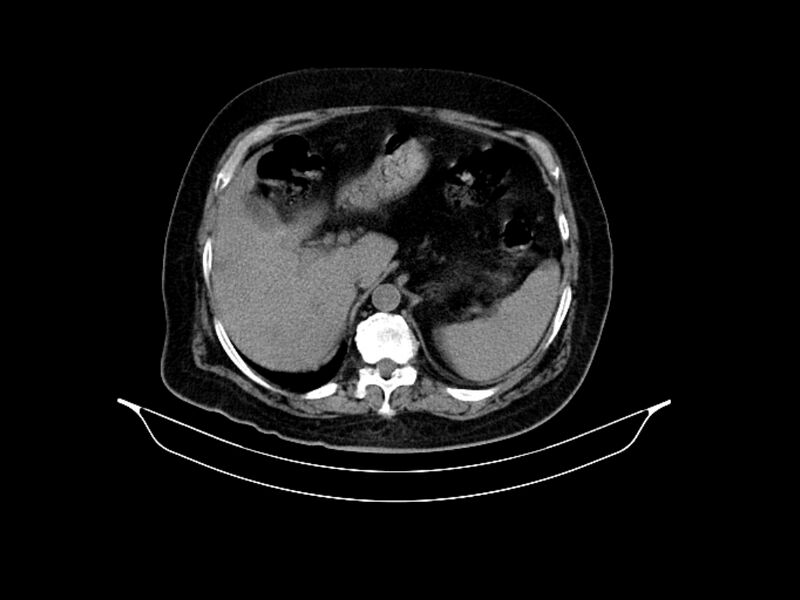 File:Adenocarcinoma of pancreas with hepatic metastasis (Radiopaedia 64332-73122 Axial non-contrast 28).jpg