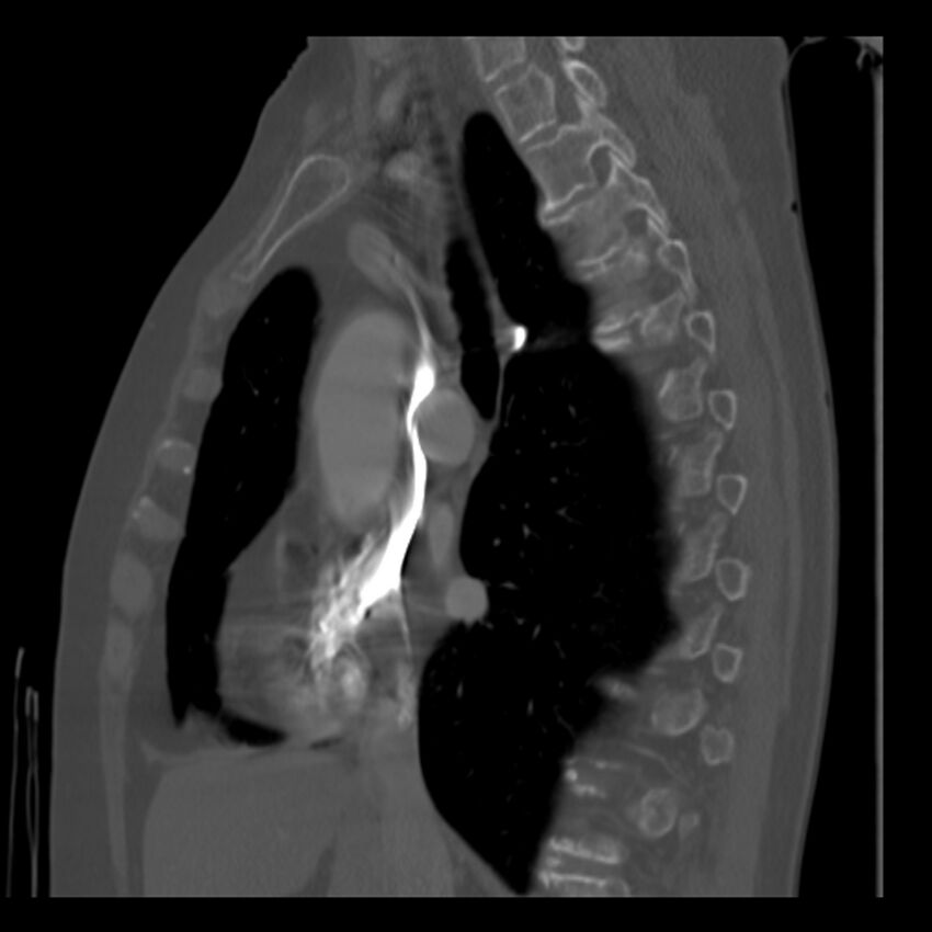 Adenocarcinoma of the lung (Radiopaedia 41015-43755 Sagittal bone window 47).jpg