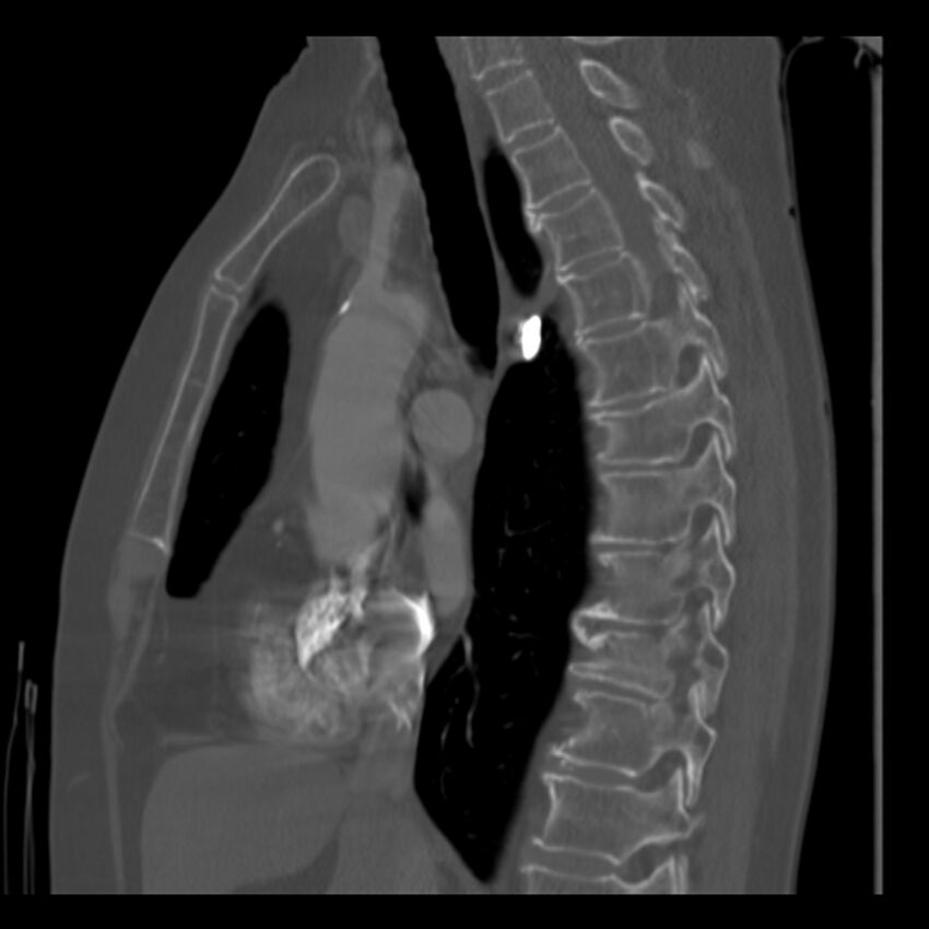 Adenocarcinoma of the lung (Radiopaedia 41015-43755 Sagittal bone window 50).jpg