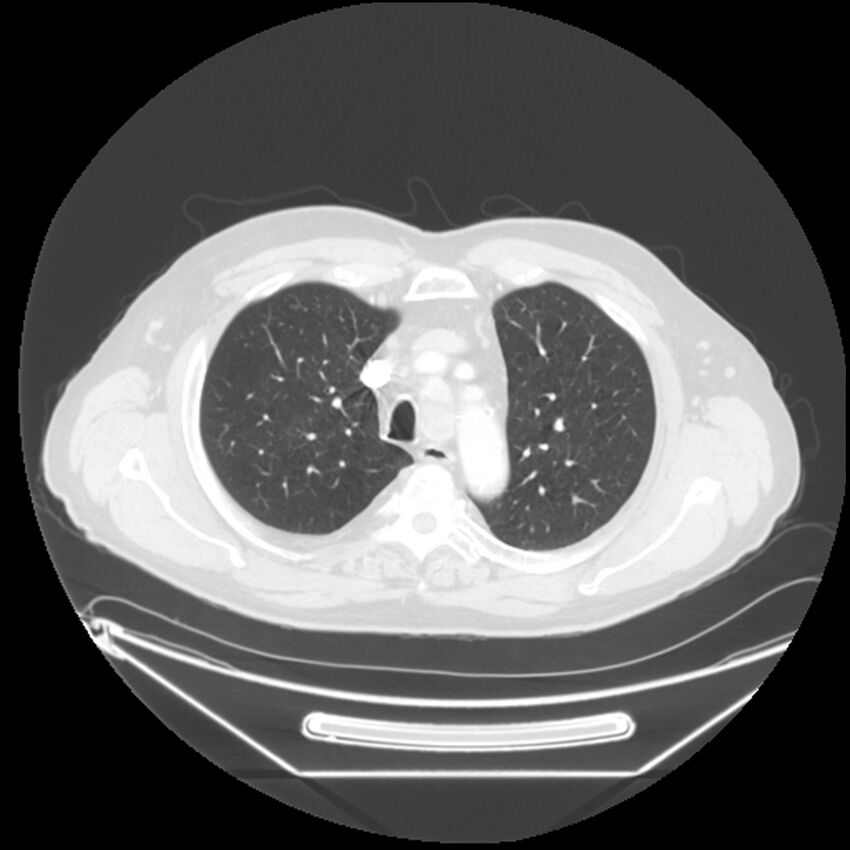Adenocarcinoma of the lung (Radiopaedia 44876-48759 Axial lung window 19).jpg
