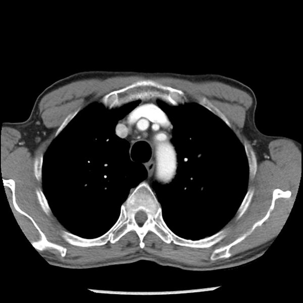 File:Adenocarcinoma of the lung - micropapillary predominant (Radiopaedia 42446-45563 Axial C+ portal venous phase 17).jpg