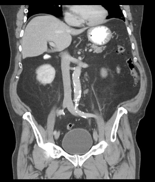 File:Adenocarcioma of rectum- T1 lesion (Radiopaedia 36921-38547 Coronal C+ portal venous phase 32).png