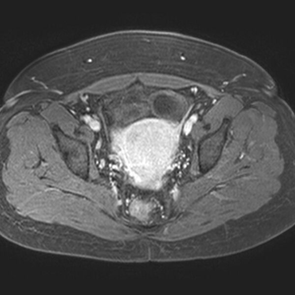 File:Adenomyoma of the uterus (Radiopaedia 9871-10439 Axial T1 C+ fat sat 12).jpg