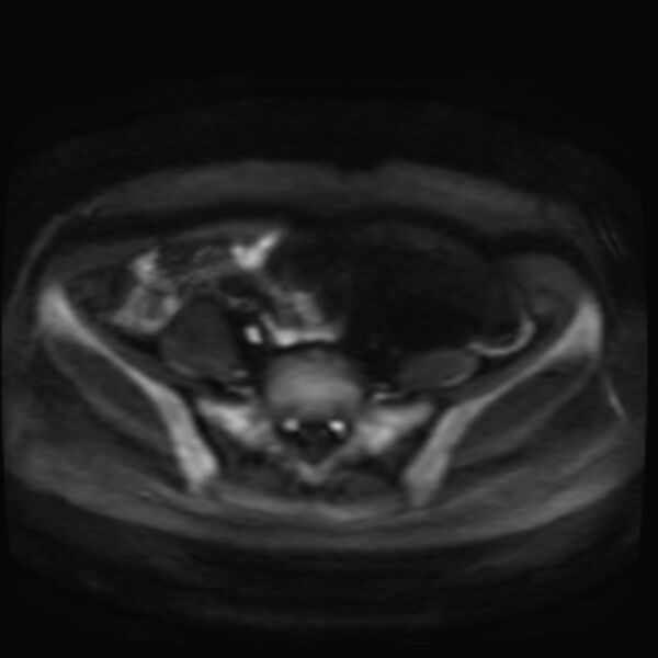 File:Adenomyosis on MRI (Radiopaedia 29328-29780 Axial DWI 1).jpg