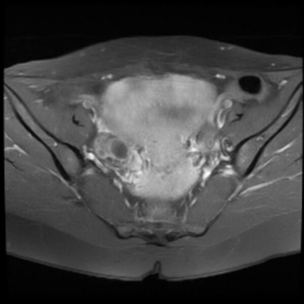 File:Adenomyosis within a septate uterus (Radiopaedia 69963-79981 Axial T1 C+ fat sat 13).jpg
