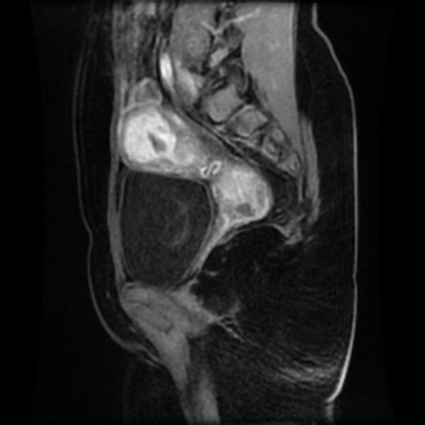 File:Adenomyosis within a septate uterus (Radiopaedia 69963-79981 Sagittal LAVA-Dyn 22).jpg