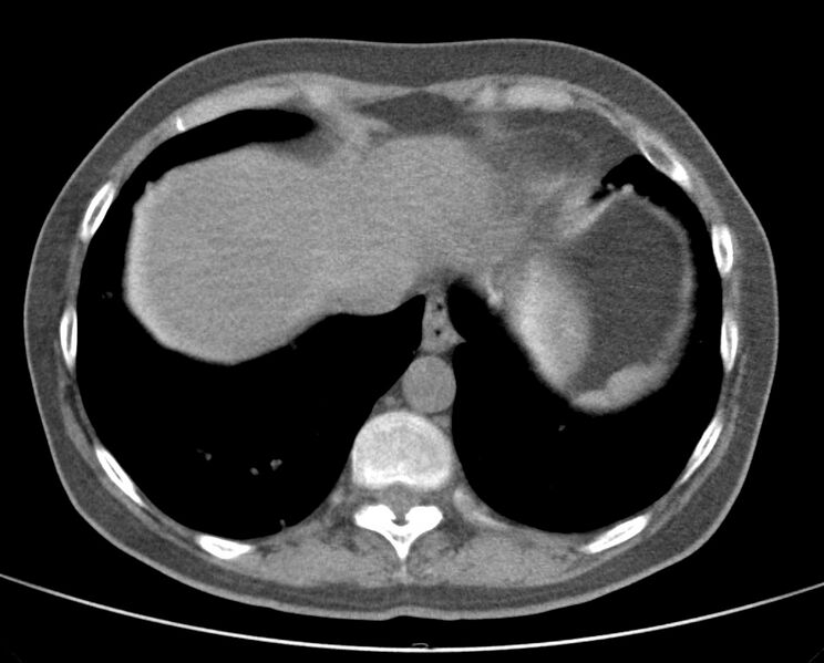 File:Adenosquamous lung carcinoma (Radiopaedia 22035-22030 non-contrast 49).jpg