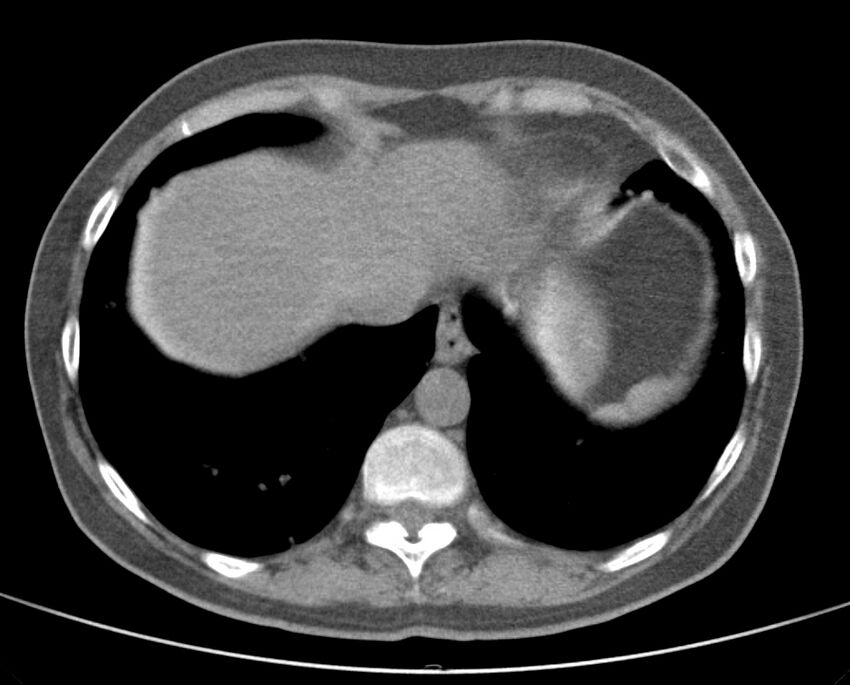 Adenosquamous lung carcinoma (Radiopaedia 22035-22030 non-contrast 49).jpg