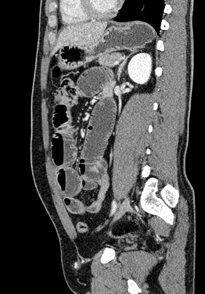 File:Adhesional small bowel obstruction (Radiopaedia 58900-66131 Sagittal C+ portal venous phase 155).jpg