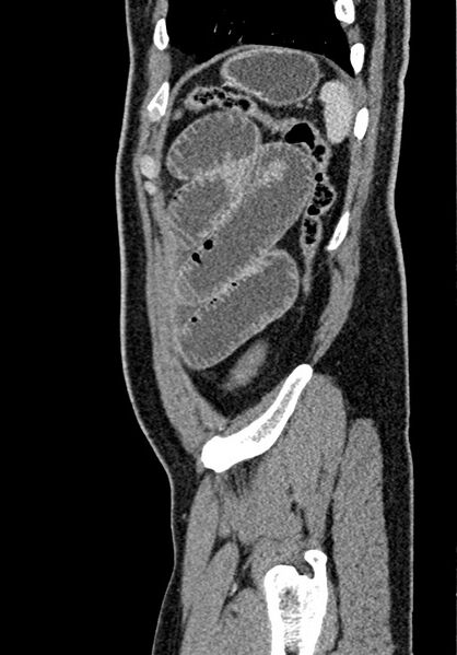 File:Adhesional small bowel obstruction (Radiopaedia 58900-66131 Sagittal C+ portal venous phase 216).jpg