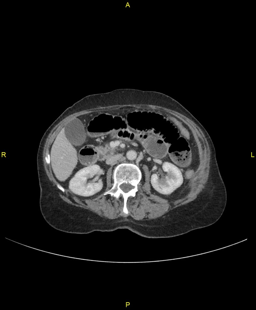 Adhesional small bowel obstruction (Radiopaedia 85402-101024 Axial C+ portal venous phase 114).jpg